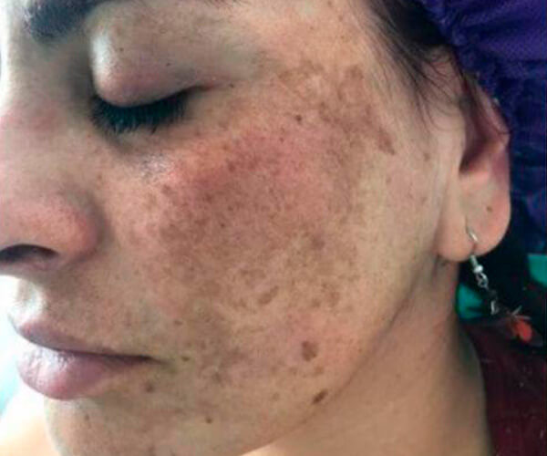 melasma01