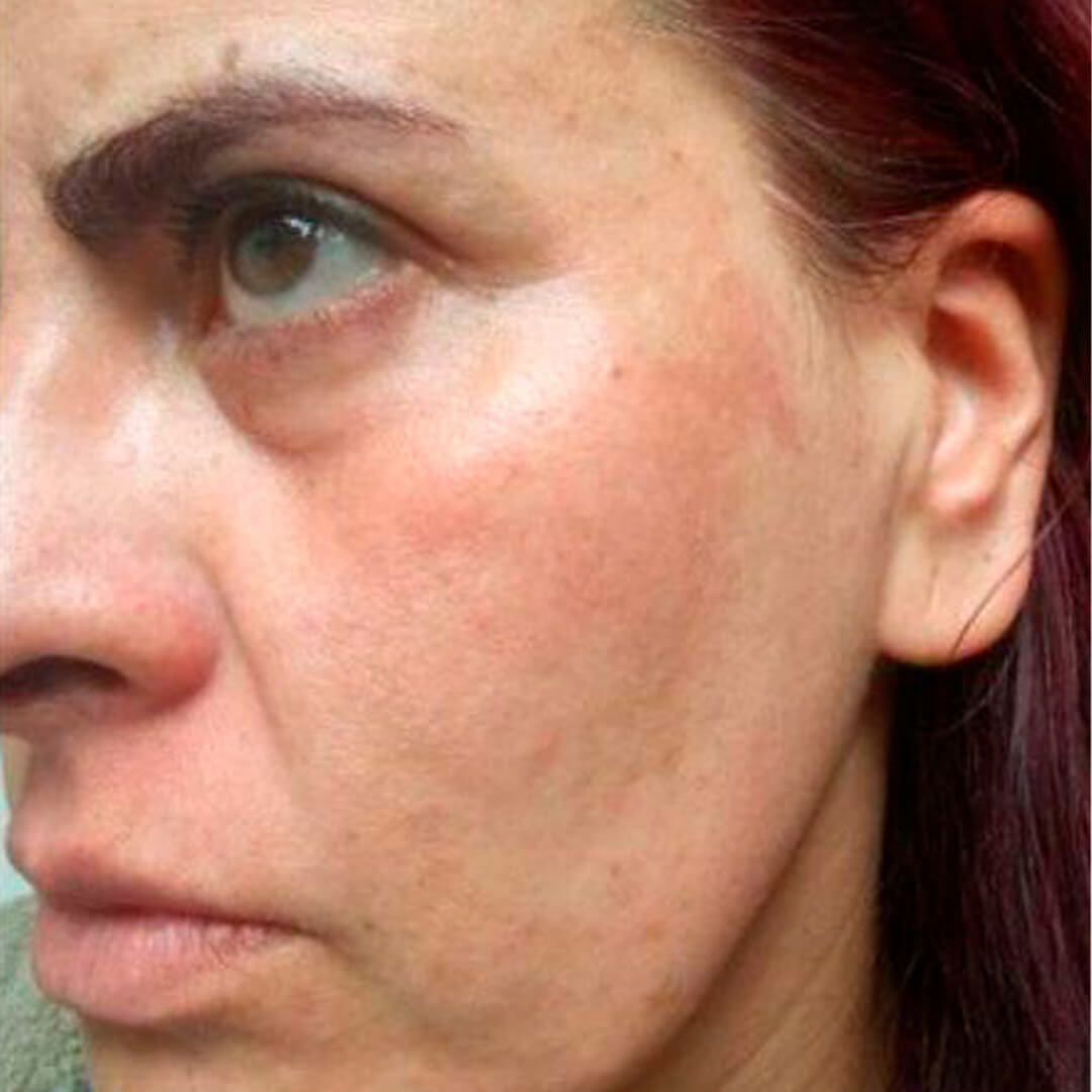 melasma02
