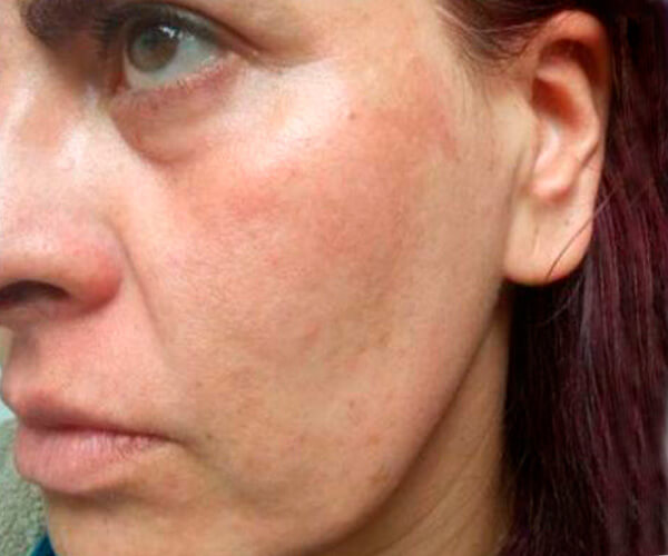 melasma02